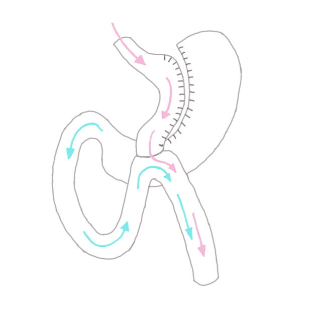 bariatric-minibypass