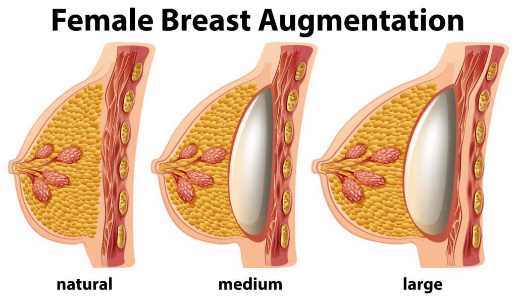 breast augmentation surgery