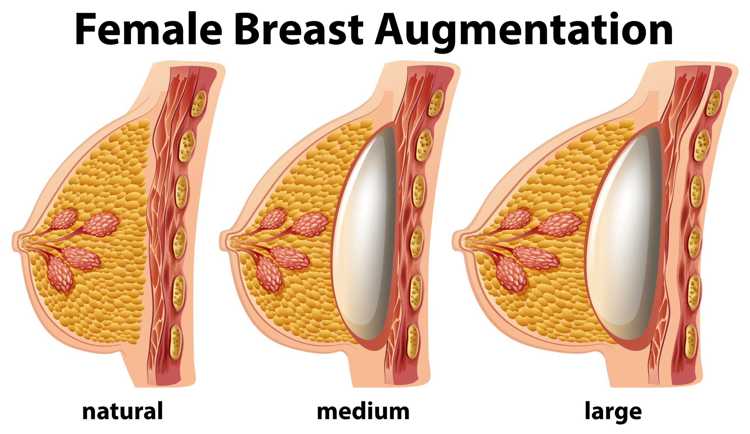 breast augmentation surgery