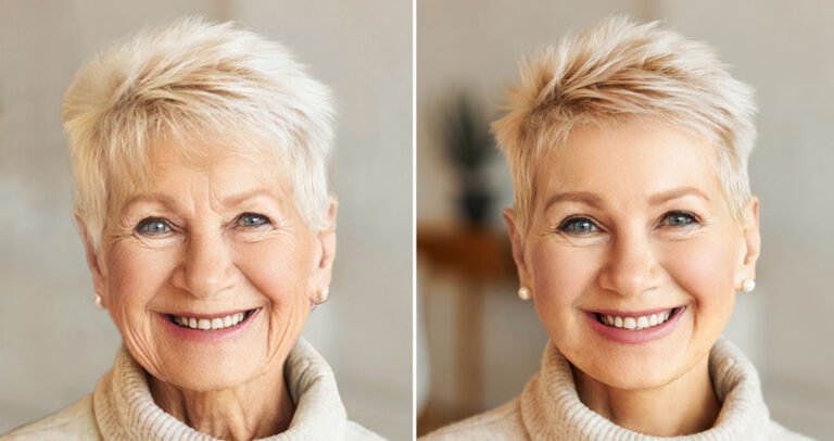 face-lift-before-after