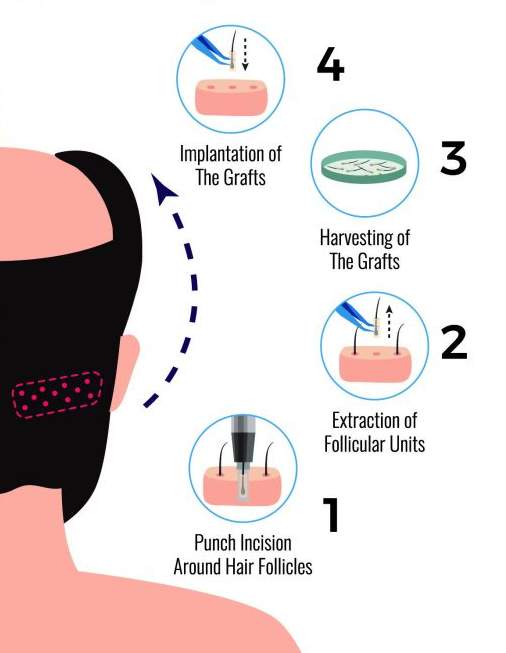 fue-hair-transplant-turkey