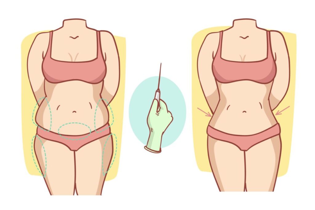liposuction exercise
