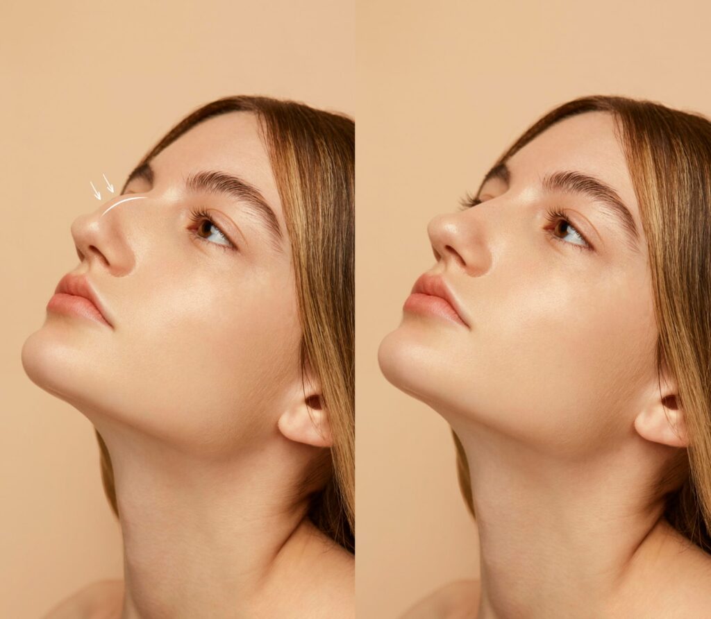 rhinoplasty treatment