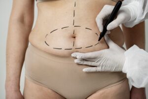 tummy tuck treatment
