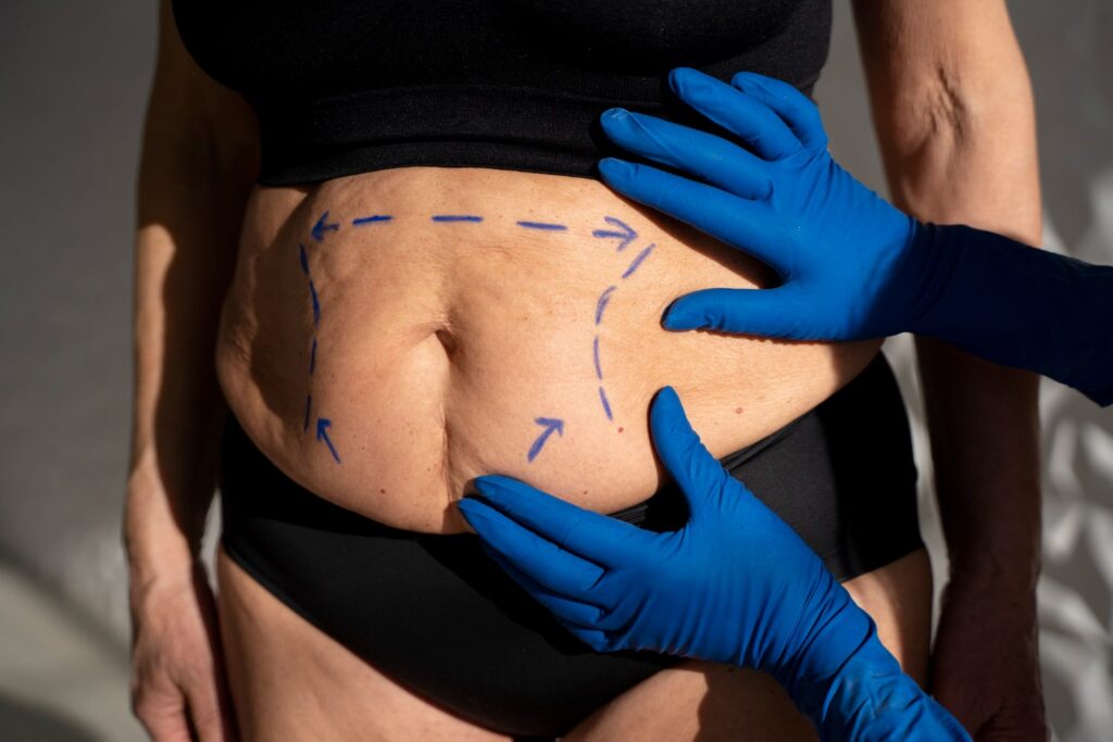 tummy tuck surgery turkey