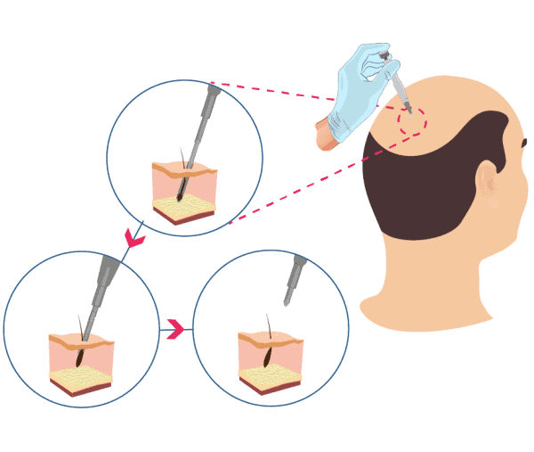 DHI-Hair-Transplant-Procedure